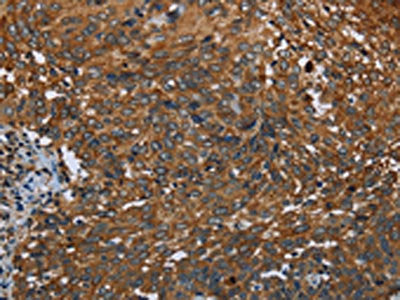 The image on the left is immunohistochemistry of paraffin-embedded Human cervical cancer tissue using CSB-PA927147(IL2RG Antibody) at dilution 1/20, on the right is treated with fusion protein. (Original magnification: ×200)
