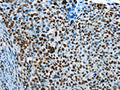 The image on the left is immunohistochemistry of paraffin-embedded Human cervical cancer tissue using CSB-PA927573(CREB1 Antibody) at dilution 1/30, on the right is treated with fusion protein. (Original magnification: ×200)