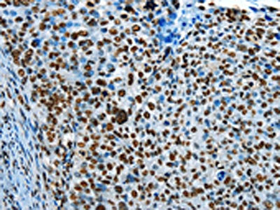 The image on the left is immunohistochemistry of paraffin-embedded Human cervical cancer tissue using CSB-PA927573(CREB1 Antibody) at dilution 1/30, on the right is treated with fusion protein. (Original magnification: ×200)