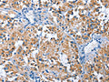 The image on the left is immunohistochemistry of paraffin-embedded Human thyroid cancer tissue using CSB-PA927575(PAK6 Antibody) at dilution 1/30, on the right is treated with fusion protein. (Original magnification: ×200)