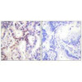 Immunohistochemical analysis of paraffin-embedded human lung carcinoma tissue using p15 INK antibody.