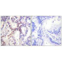 Immunohistochemical analysis of paraffin-embedded human lung carcinoma tissue using p15 INK antibody.