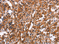 The image on the left is immunohistochemistry of paraffin-embedded Human thyroid cancer tissue using CSB-PA928010(MAPK11  Antibody) at dilution 1/15, on the right is treated with synthetic peptide. (Original magnification: ×200)