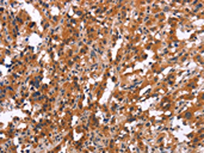 The image on the left is immunohistochemistry of paraffin-embedded Human thyroid cancer tissue using CSB-PA928010(MAPK11  Antibody) at dilution 1/15, on the right is treated with synthetic peptide. (Original magnification: ×200)