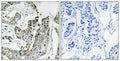 Immunohistochemical analysis of paraffin-embedded human breast carcinoma tissue using BLK (Phospho-Tyr501) antibody (left)or the same antibody preincubated with blocking peptide (right).