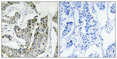 Immunohistochemical analysis of paraffin-embedded human breast carcinoma tissue using BLK (Phospho-Tyr501) antibody (left)or the same antibody preincubated with blocking peptide (right).