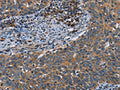 The image on the left is immunohistochemistry of paraffin-embedded Human cervical cancer tissue using CSB-PA928714(HYAL3 Antibody) at dilution 1/40, on the right is treated with fusion protein. (Original magnification: ×200)