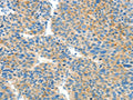 The image on the left is immunohistochemistry of paraffin-embedded Human liver cancer tissue using CSB-PA928784(BCAT1 Antibody) at dilution 1/50, on the right is treated with fusion protein. (Original magnification: ×200)