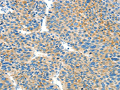 The image on the left is immunohistochemistry of paraffin-embedded Human liver cancer tissue using CSB-PA928784(BCAT1 Antibody) at dilution 1/50, on the right is treated with fusion protein. (Original magnification: ×200)