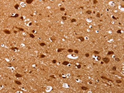 The image on the left is immunohistochemistry of paraffin-embedded Human brain tissue using CSB-PA928820(PSMD3 Antibody) at dilution 1/25, on the right is treated with fusion protein. (Original magnification: ×200)