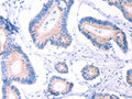 The image on the left is immunohistochemistry of paraffin-embedded Human colon cancer tissue using CSB-PA928876(AADAC Antibody) at dilution 1/30, on the right is treated with fusion protein. (Original magnification: ×200)