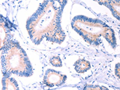 The image on the left is immunohistochemistry of paraffin-embedded Human colon cancer tissue using CSB-PA928876(AADAC Antibody) at dilution 1/30, on the right is treated with fusion protein. (Original magnification: ×200)