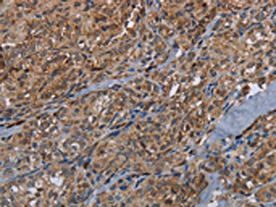 The image on the left is immunohistochemistry of paraffin-embedded Human thyroid cancer tissue using CSB-PA929004(HMGCR Antibody) at dilution 1/20, on the right is treated with fusion protein. (Original magnification: ×200)