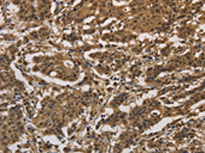 The image on the left is immunohistochemistry of paraffin-embedded Human gastic cancer tissue using CSB-PA929092(DUSP23 Antibody) at dilution 1/20, on the right is treated with fusion protein. (Original magnification: ×200)