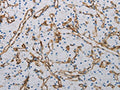 The image on the left is immunohistochemistry of paraffin-embedded Human renal cancer tissue using CSB-PA929097(PECAM1 Antibody) at dilution 1/40, on the right is treated with synthetic peptide. (Original magnification: ×200)