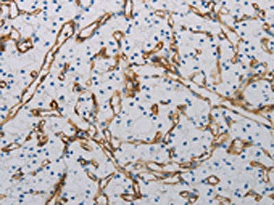 The image on the left is immunohistochemistry of paraffin-embedded Human renal cancer tissue using CSB-PA929097(PECAM1 Antibody) at dilution 1/40, on the right is treated with synthetic peptide. (Original magnification: ×200)