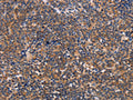 The image on the left is immunohistochemistry of paraffin-embedded Human lymphoma tissue using CSB-PA929212(ALG9 Antibody) at dilution 1/30, on the right is treated with fusion protein. (Original magnification: ×200)