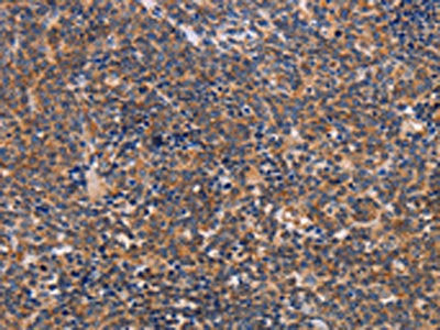 The image on the left is immunohistochemistry of paraffin-embedded Human lymphoma tissue using CSB-PA929212(ALG9 Antibody) at dilution 1/30, on the right is treated with fusion protein. (Original magnification: ×200)