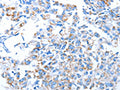 The image on the left is immunohistochemistry of paraffin-embedded Human breast cancer tissue using CSB-PA929439(ALAS1 Antibody) at dilution 1/30, on the right is treated with fusion protein. (Original magnification: ×200)