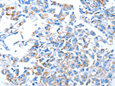 The image on the left is immunohistochemistry of paraffin-embedded Human breast cancer tissue using CSB-PA929439(ALAS1 Antibody) at dilution 1/30, on the right is treated with fusion protein. (Original magnification: ×200)