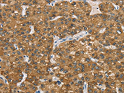 The image on the left is immunohistochemistry of paraffin-embedded Human liver cancer tissue using CSB-PA929748(ENTPD5 Antibody) at dilution 1/20, on the right is treated with fusion protein. (Original magnification: ×200)