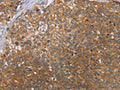 The image on the left is immunohistochemistry of paraffin-embedded Human cervical cancer tissue using CSB-PA929761(CCL21 Antibody) at dilution 1/40, on the right is treated with fusion protein. (Original magnification: ×200)