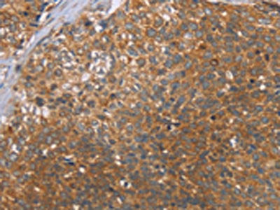 The image on the left is immunohistochemistry of paraffin-embedded Human cervical cancer tissue using CSB-PA929761(CCL21 Antibody) at dilution 1/40, on the right is treated with fusion protein. (Original magnification: ×200)