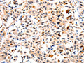 The image on the left is immunohistochemistry of paraffin-embedded Human lung cancer tissue using CSB-PA929770(IL23R Antibody) at dilution 1/10, on the right is treated with fusion protein. (Original magnification: ×200)