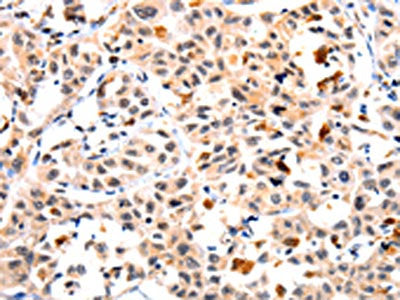 The image on the left is immunohistochemistry of paraffin-embedded Human lung cancer tissue using CSB-PA929770(IL23R Antibody) at dilution 1/10, on the right is treated with fusion protein. (Original magnification: ×200)