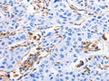 The image on the left is immunohistochemistry of paraffin-embedded Human lung cancer tissue using CSB-PA929799(MFN1 Antibody) at dilution 1/60, on the right is treated with fusion protein. (Original magnification: ×200)
