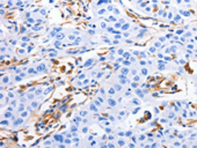 The image on the left is immunohistochemistry of paraffin-embedded Human lung cancer tissue using CSB-PA929799(MFN1 Antibody) at dilution 1/60, on the right is treated with fusion protein. (Original magnification: ×200)