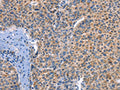 The image on the left is immunohistochemistry of paraffin-embedded Human liver cancer tissue using CSB-PA929814(DUSP10 Antibody) at dilution 1/25, on the right is treated with fusion protein. (Original magnification: ×200)