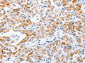 The image on the left is immunohistochemistry of paraffin-embedded Human lung cancer tissue using CSB-PA929866(MMP10 Antibody) at dilution 1/15, on the right is treated with synthetic peptide. (Original magnification: ×200)
