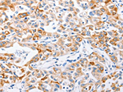 The image on the left is immunohistochemistry of paraffin-embedded Human lung cancer tissue using CSB-PA929866(MMP10 Antibody) at dilution 1/15, on the right is treated with synthetic peptide. (Original magnification: ×200)