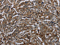 The image on the left is immunohistochemistry of paraffin-embedded Human liver cancer tissue using CSB-PA929928(GLUL Antibody) at dilution 1/60, on the right is treated with fusion protein. (Original magnification: ×200)