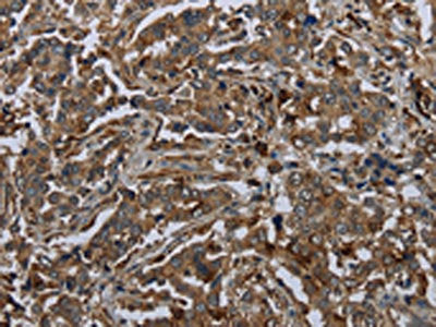 The image on the left is immunohistochemistry of paraffin-embedded Human liver cancer tissue using CSB-PA929928(GLUL Antibody) at dilution 1/60, on the right is treated with fusion protein. (Original magnification: ×200)