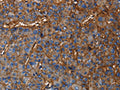 The image on the left is immunohistochemistry of paraffin-embedded Human liver cancer tissue using CSB-PA930156(CD46 Antibody) at dilution 1/30, on the right is treated with fusion protein. (Original magnification: ×200)