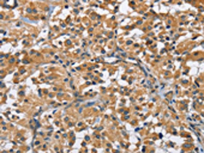 The image on the left is immunohistochemistry of paraffin-embedded Human thyroid cancer tissue using CSB-PA930678(FLT3 Antibody) at dilution 1/50, on the right is treated with fusion protein. (Original magnification: ×200)