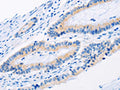 The image on the left is immunohistochemistry of paraffin-embedded Human colon cancer tissue using CSB-PA930762(BMP3 Antibody) at dilution 1/30, on the right is treated with fusion protein. (Original magnification: ×200)
