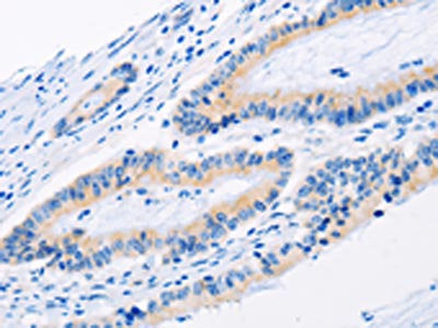 The image on the left is immunohistochemistry of paraffin-embedded Human colon cancer tissue using CSB-PA930762(BMP3 Antibody) at dilution 1/30, on the right is treated with fusion protein. (Original magnification: ×200)