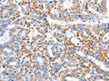 The image on the left is immunohistochemistry of paraffin-embedded Human thyroid cancer tissue using CSB-PA930766(CLEC1B Antibody) at dilution 1/15, on the right is treated with fusion protein. (Original magnification: x200)