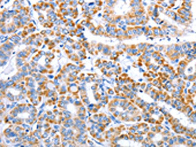The image on the left is immunohistochemistry of paraffin-embedded Human thyroid cancer tissue using CSB-PA930766(CLEC1B Antibody) at dilution 1/15, on the right is treated with fusion protein. (Original magnification: x200)