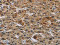 The image on the left is immunohistochemistry of paraffin-embedded Human liver cancer tissue using CSB-PA930930(IL31 Antibody) at dilution 1/20, on the right is treated with synthetic peptide. (Original magnification: X200)