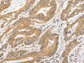 The image on the left is immunohistochemistry of paraffin-embedded Human colon cancer tissue using CSB-PA931023(ATG5 Antibody) at dilution 1/40, on the right is treated with fusion protein. (Original magnification: ×200)