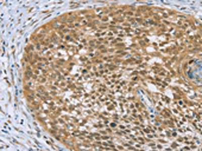 The image on the left is immunohistochemistry of paraffin-embedded Human cervical cancer tissue using CSB-PA931107(EDIL3 Antibody) at dilution 1/20, on the right is treated with fusion protein. (Original magnification: ×200)