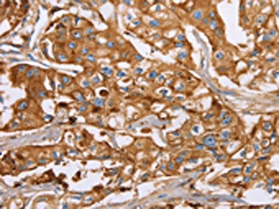 The image on the left is immunohistochemistry of paraffin-embedded Human breast cancer tissue using CSB-PA931199(LTF Antibody) at dilution 1/40, on the right is treated with fusion protein. (Original magnification: ×200)