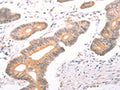 The image on the left is immunohistochemistry of paraffin-embedded Human colon cancer tissue using CSB-PA931399(ABCF2 Antibody) at dilution 1/25, on the right is treated with fusion protein. (Original magnification: ×200)