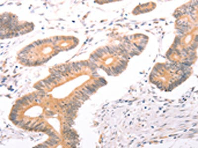 The image on the left is immunohistochemistry of paraffin-embedded Human colon cancer tissue using CSB-PA931399(ABCF2 Antibody) at dilution 1/25, on the right is treated with fusion protein. (Original magnification: ×200)