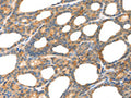 The image on the left is immunohistochemistry of paraffin-embedded Human thyroid cancer tissue using CSB-PA931886(POU2F2 Antibody) at dilution 1/80, on the right is treated with fusion protein. (Original magnification: ×200)