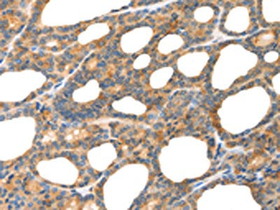 The image on the left is immunohistochemistry of paraffin-embedded Human thyroid cancer tissue using CSB-PA931886(POU2F2 Antibody) at dilution 1/80, on the right is treated with fusion protein. (Original magnification: ×200)